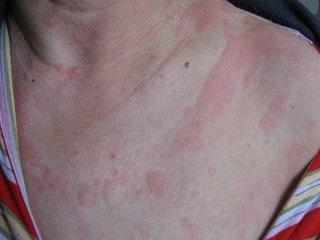 5年荨麻疹,用它磨粉这样用,快速止痒,一治一个好