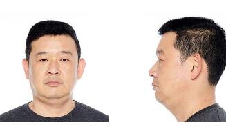 男士面部提升整形 油腻男逆袭之路