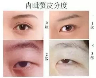 打死都不开眼角，然后我的双眼皮做成了这样~