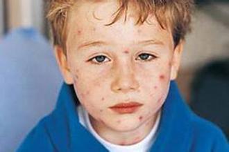 荨麻疹的五大误区,你知道吗?荨麻疹这样治,简