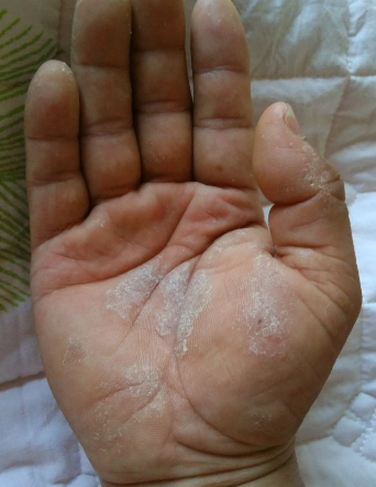 得了手癣怎么治疗?农村土方法简单又有效