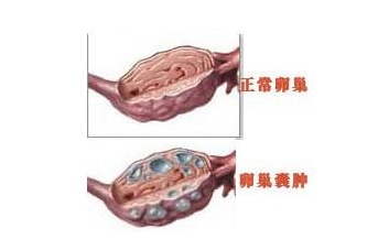 卵巢囊肿早期有什么症状会影响生育吗