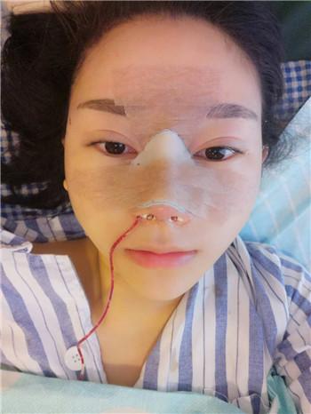 刚做完鼻综合像个猪头,现在这样也算值了-提供