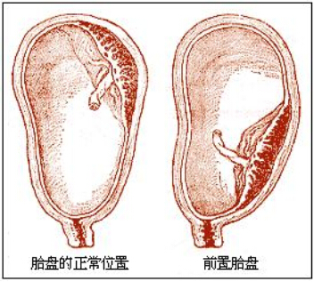 孕期前置胎盘与后置胎盘的区别和危害你知道多少?