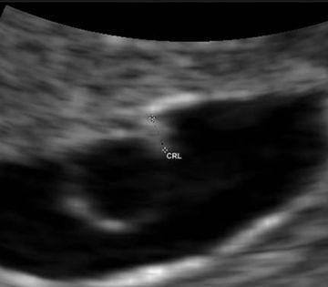 怀孕早期:孕期1-7周胎儿发育全过程,第7周时像