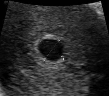 怀孕早期:孕期1-7周胎儿发育全过程,第7周时像