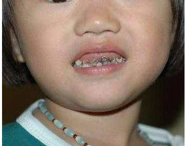 没给女儿没吃过糖,她却一口黑烂牙,牙医把母亲