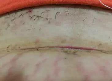 孕妈剖腹产手术几个月, 伤口突然裂开, 去医院检查后医生都慌了