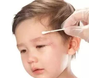 注意!宝宝头部摔伤的24小时内,你一定要这么做