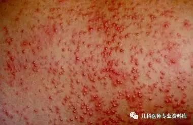 专家指导:儿童常见的皮肤病如何辨识、治疗和