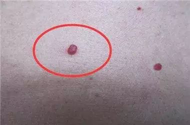 提醒:身上长出两种红点,肝功正常也存在肝损