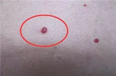 提醒:身上长出两种红点,肝功正常也存在肝损