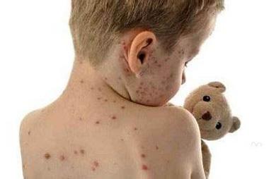 感冒和脑膜炎如何区分?别再傻傻耽误孩子的病