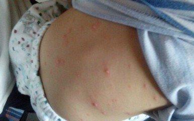 幼儿各种疹子的症状及护理方法,实用!