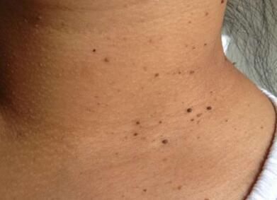 脖子上长出好多小肉粒, 可能是身体这个地方出