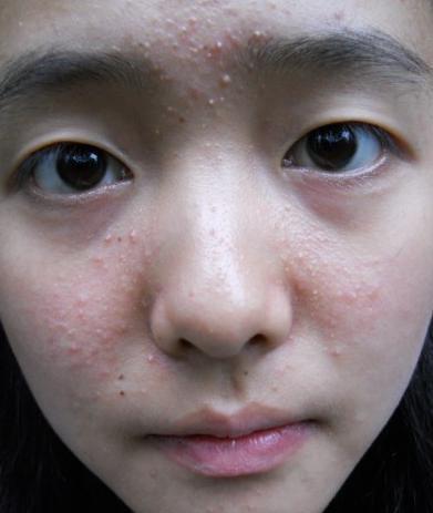 走近看到满脸闭口痘痘,马上灭灯! 闭口痘痘如何快速消掉