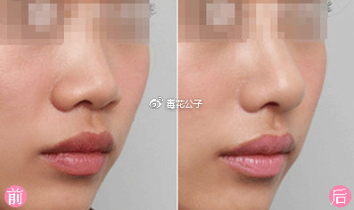 韩式隆鼻手术效果好不好，韩式隆鼻有什么后遗症？
