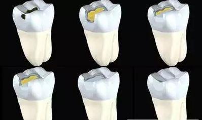 我有个疑惑,补牙的材料究竟会不会掉?