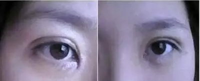 打死都不开眼角，然后我的双眼皮做成了这样~