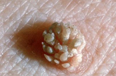 菜花型尖锐湿疣在临床上最为常见,损害开始为顶端稍尖的丘疹,有的呈