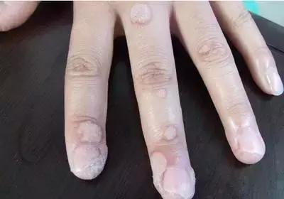 寻常疣怎么办 艾灸解决方法这样做