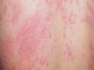 荨麻疹难受?一植物,治荨麻疹的特效药,一治一