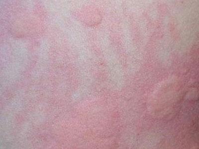 为何荨麻疹午后和夜间加重?老中医出高招,简