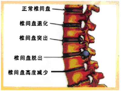 腰间盘突出，引起的腰腿酸痛怎么了