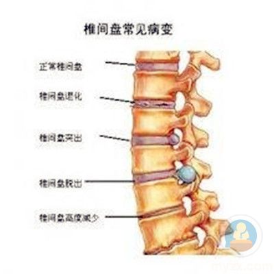 腰疼不是腰椎间盘突出症,身体出现这些变化才是