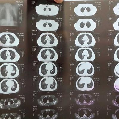 背痛、肩痛竟是肺癌前兆:提前这么做,治愈率提