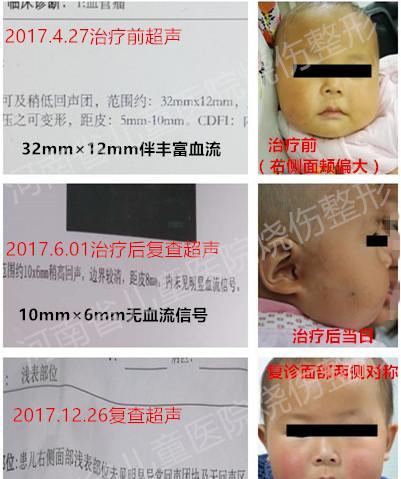 当心这种血管瘤：腮腺血管瘤！