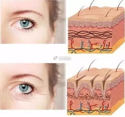 线雕提升面部埋线提升,皮肤松弛下垂的你必看