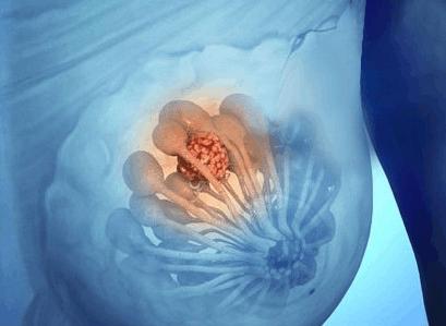乳腺增生会出现哪些症状?