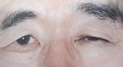 人老了,怎么连眼睛都睁不大了