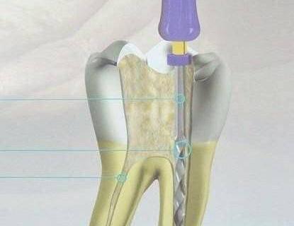 牙齿做过根管治疗后,还能使用多久