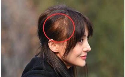 明星脱发哪家强?焦恩俊脱发照老了二十岁,沙溢