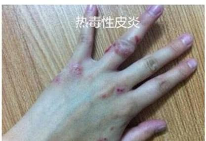 热毒性皮炎湿疹