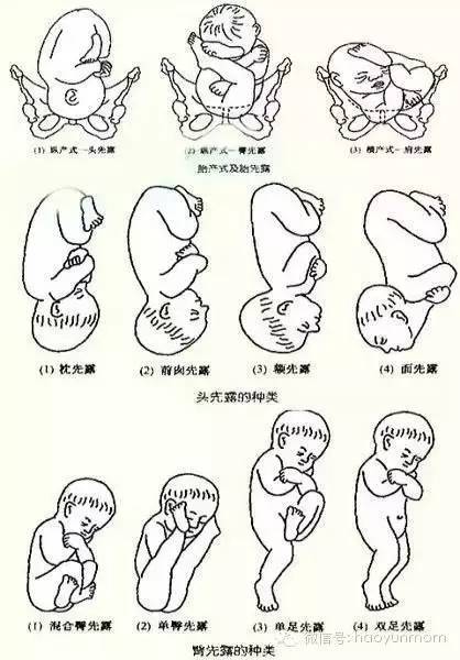 了解胎位不正,为分娩做好准备