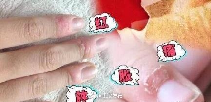 女白领随手撕倒刺感染,手指肿成萝卜!