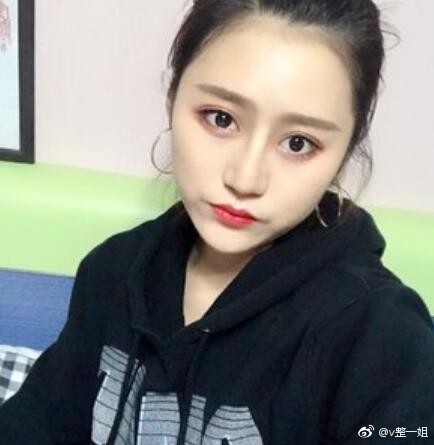 北京隆鼻手术案例分享,术后三个月恢复过程。