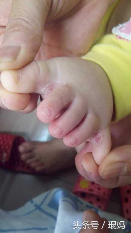宝宝脚趾丫好像有脚气,你们家宝宝有这样的吗?