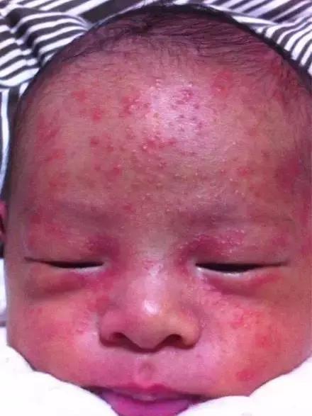 1个月婴儿脸上长疙瘩,儿科专家来支招,湿疹、