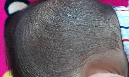 宝宝晚上睡觉出汗厉害连枕头都湿了,看这个宝