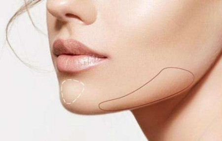 整颧骨配合下颌角整形是不是效果会更好?