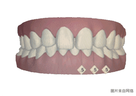深覆颌/ 深覆颌指的是上颌牙齿咬合时严重覆盖下颌牙齿的情况.