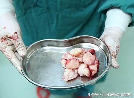 二胎孕妈34周被"踢爆"子宫,母子险些丧命,医生怒斥"无