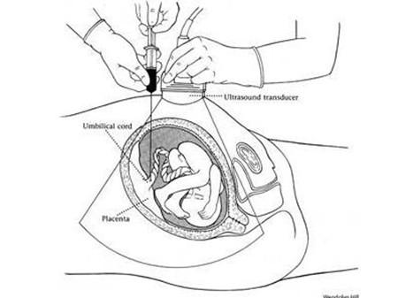 高龄孕妇需要做哪些检查 高龄产妇必做的六种