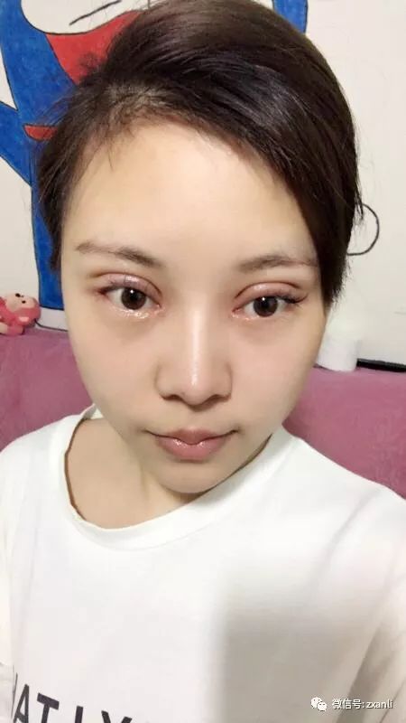 全切双眼皮修复,之前做过埋线双眼皮,现在变三眼皮了