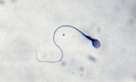 备孕两年没怀孕,一查才知道男人精子活力太低