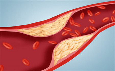 血管硬化可以逆转，经常做1个动作可软化血管、溶血栓!